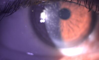 Digital image depicting multiple subepithelial scars post viral keratitis causing astigmatism