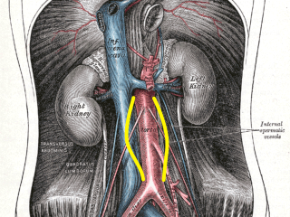 Abdominal Aortic Aneurysm Illustration. Distention shown by yellow markings. Includes aorta, inferior vena cava, and aneurysms.