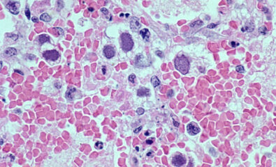 Adenovirus, Smudge Cells