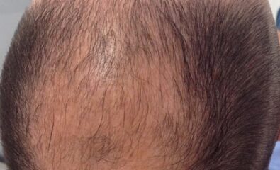 Male-Pattern Androgenetic Alopecia. Hair loss from frontal, temporal, and central scalp areas.