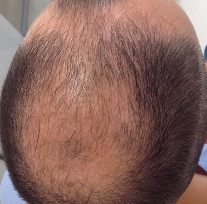 Male-Pattern Androgenetic Alopecia. Hair loss from frontal, temporal, and central scalp areas.