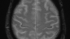 MRI GRE sequence demonstrating iron deposition in the precentral gyrus (motor band sign) in a patient with amyotrophic lateral sclerosis.