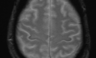 MRI GRE sequence demonstrating iron deposition in the precentral gyrus (motor band sign) in a patient with amyotrophic lateral sclerosis.