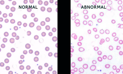 Iron deficiency anemia