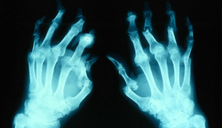 An X-ray of Arthritis Mutilans of hands