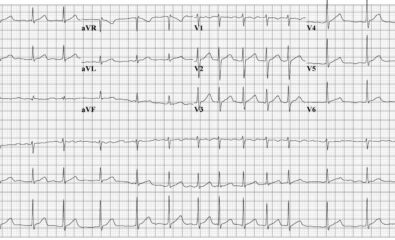 ECG for an Atrial fibrillation's case.