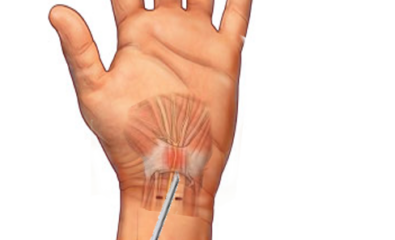 Carpal Tunnel Syndrome