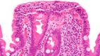 Very high magnification micrograph of celiac disease. H&E stain