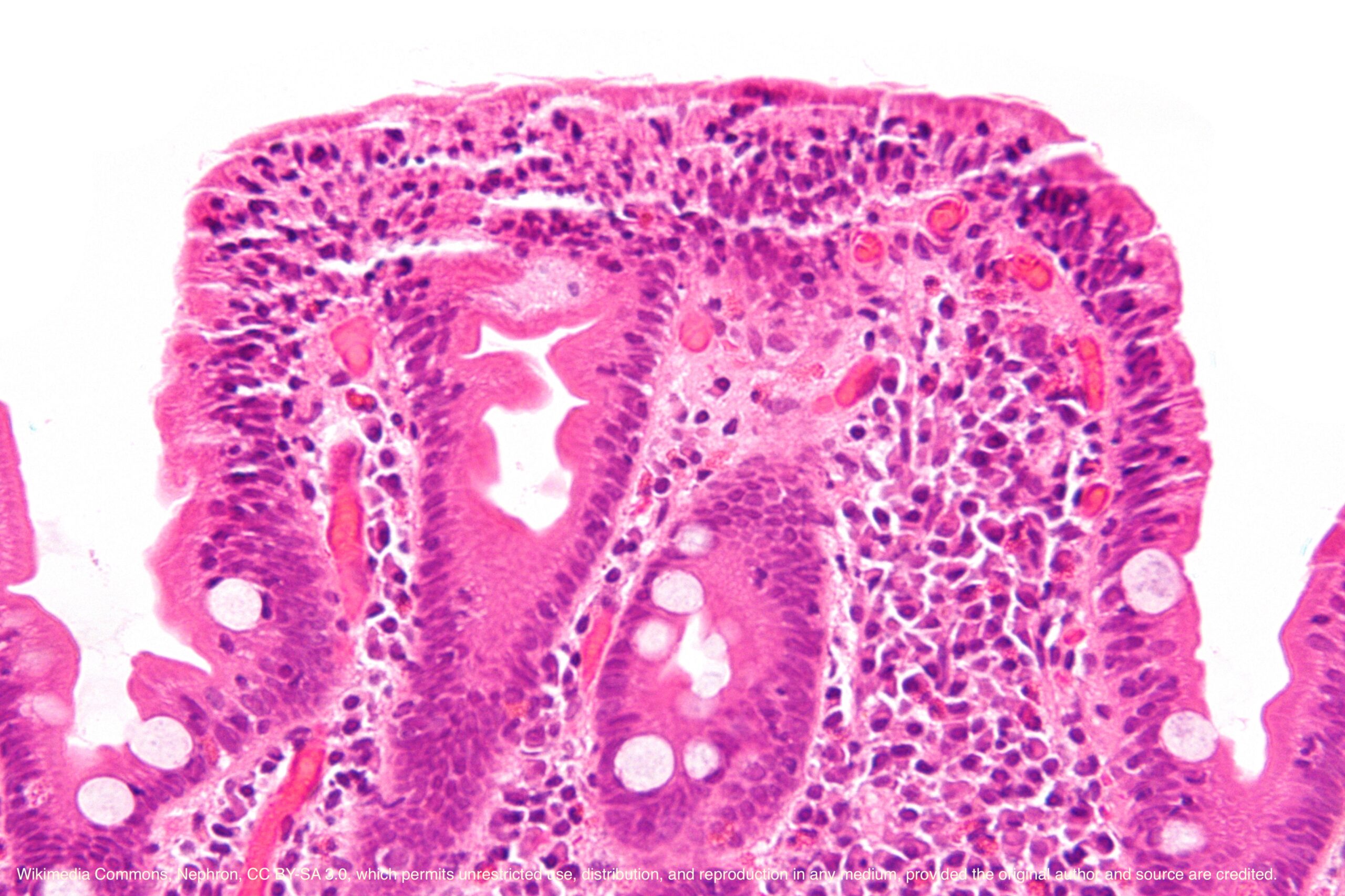 Celiac Disease - MD Searchlight Celiac Disease - MD Searchlight
