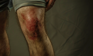 Man with Cellulitis