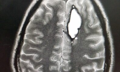 Another patient 30 years lf presented with altered consciousness MRI brain reveals superficially located AVM with aneurysm formation and intraparenchymal bleed