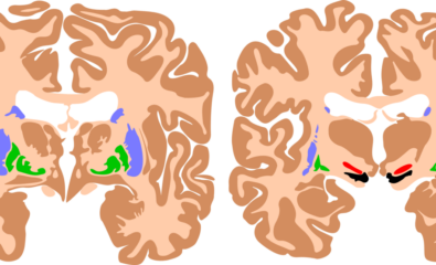 Basal Ganglia, Cerebral Palsy Brain. The basal ganglia are instrumental in motor function. Damage to these areas results in athetoid/dyskinetic cerebral palsy.