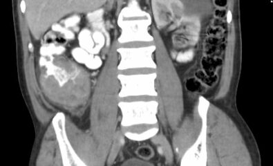 Right-Sided Colon Cancer on Computed Tomography. 