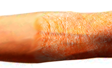 Atopic dermatitis
