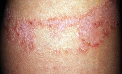 Contact Allergy From Band-Aid