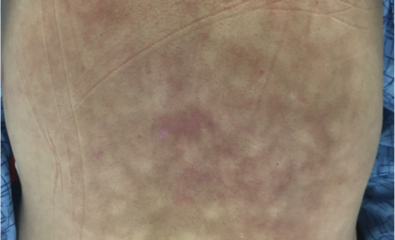 Erythema ab Igne, Back
