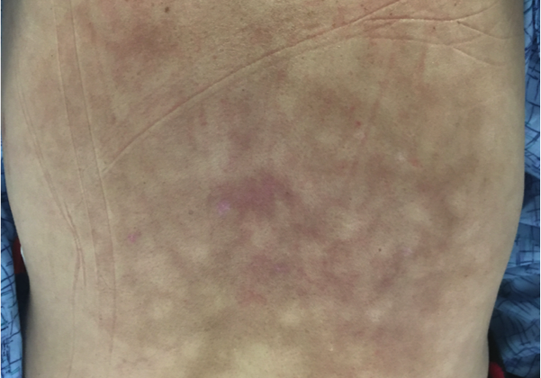 Erythema ab Igne, Back
