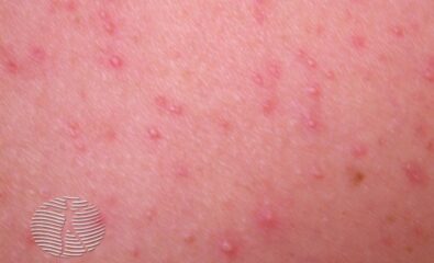 Malassezia folliculitis - small, erythematous papules and pustules