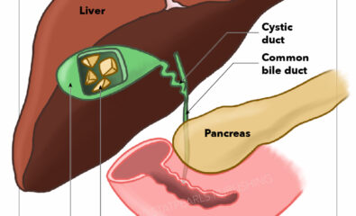 Gallbladder Gallstones (Calculi), Common bile duct, Pancreas, Intestine, Gallbladder, Gallstones, Liver