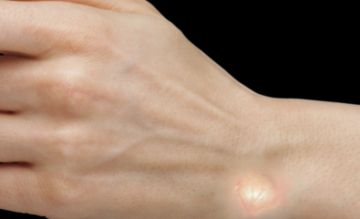 Ganglion Cyst