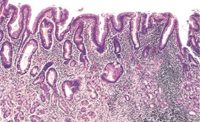 Histopathology of Chronic Gastritis. This image displays gastric mucosal atrophy with high lymphocytic infiltrate.