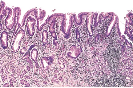 Histopathology of Chronic Gastritis. This image displays gastric mucosal atrophy with high lymphocytic infiltrate.