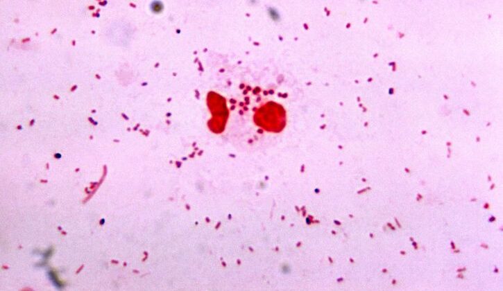 Gram Stain, dipplococcus, Gonorrhea,