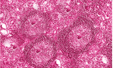 Hashimoto Thyroiditis