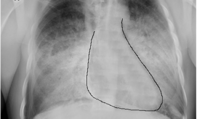 Congestive Heart Failure