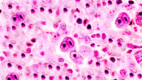 Reed Sternberg Cells Lymphoma