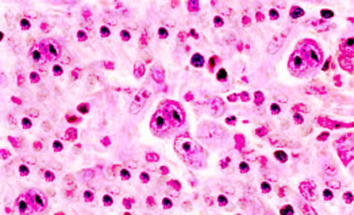 Reed Sternberg Cells Lymphoma