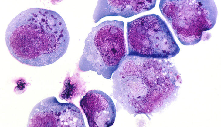 This is a histological slide of the human herpes virus-6 (HHV-6) previously known as HBLV, a type of herpes virus that was discovered in October, 1986. This is a photomicrograph of infected cells, with inclusion bodies in both the nucleus and the cytoplasm. The slide is stained with H&E. Roseola infantum is caused by this type of virus.