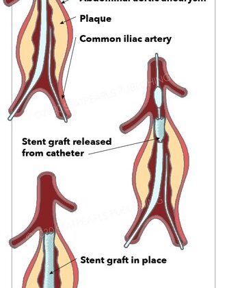 Abdominal Aorta Repair, aneurysm, common iliac artery, stent graft released from catheter