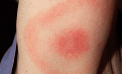 Lyme Disease "Bulls-Eye" Rash.