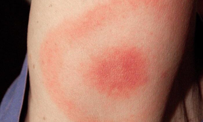 Lyme Disease "Bulls-Eye" Rash.