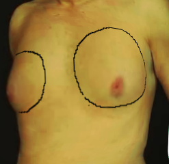 Gynecomastia