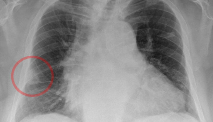 Hampton Hump Visualized on Chest Xray. A shallow, hump-shaped opacity on CXR in the periphery of the lung is characteristic of Hampton Hump, indicating pulmonary embolism.