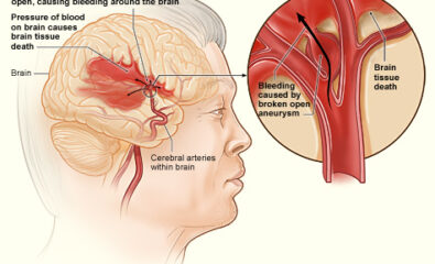 The illustration shows how a hemorrhagic stroke can occur in the brain. An aneurysm in a cerebral artery breaks open, which causes bleeding in the brain. The pressure of the blood causes brain tissue death.