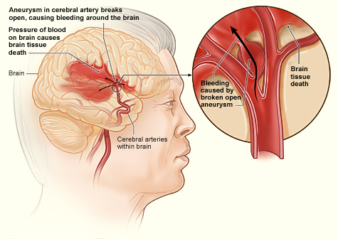 The illustration shows how a hemorrhagic stroke can occur in the brain. An aneurysm in a cerebral artery breaks open, which causes bleeding in the brain. The pressure of the blood causes brain tissue death.