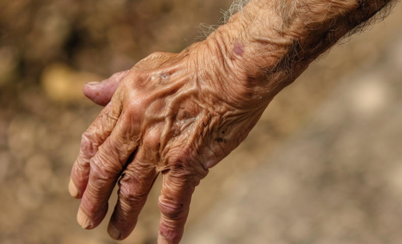 Arthritis Archives - MD Searchlight - Cat Rheumatoid Arthritis Symptoms Timeline