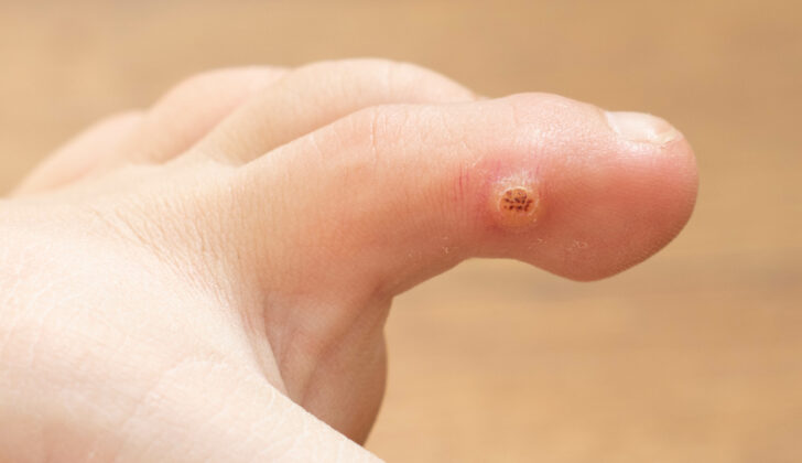 Wart on toe