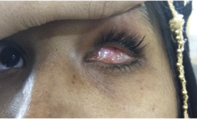 25 year old female with grade 2 contracted socket