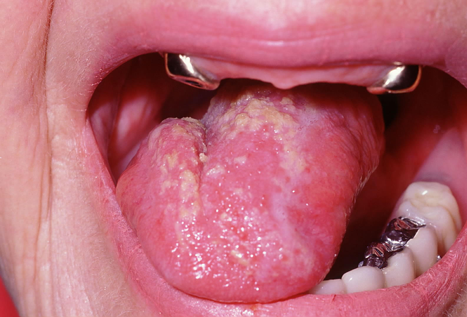 Oral candidiasis hi-res stock photography and images - Alamy, image size:1586x1076
