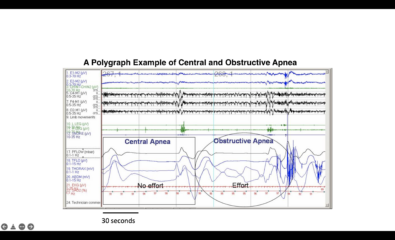 Central and Obstructive Apnea, Polygraph. The image depicts an example of central and obstructive apnea.