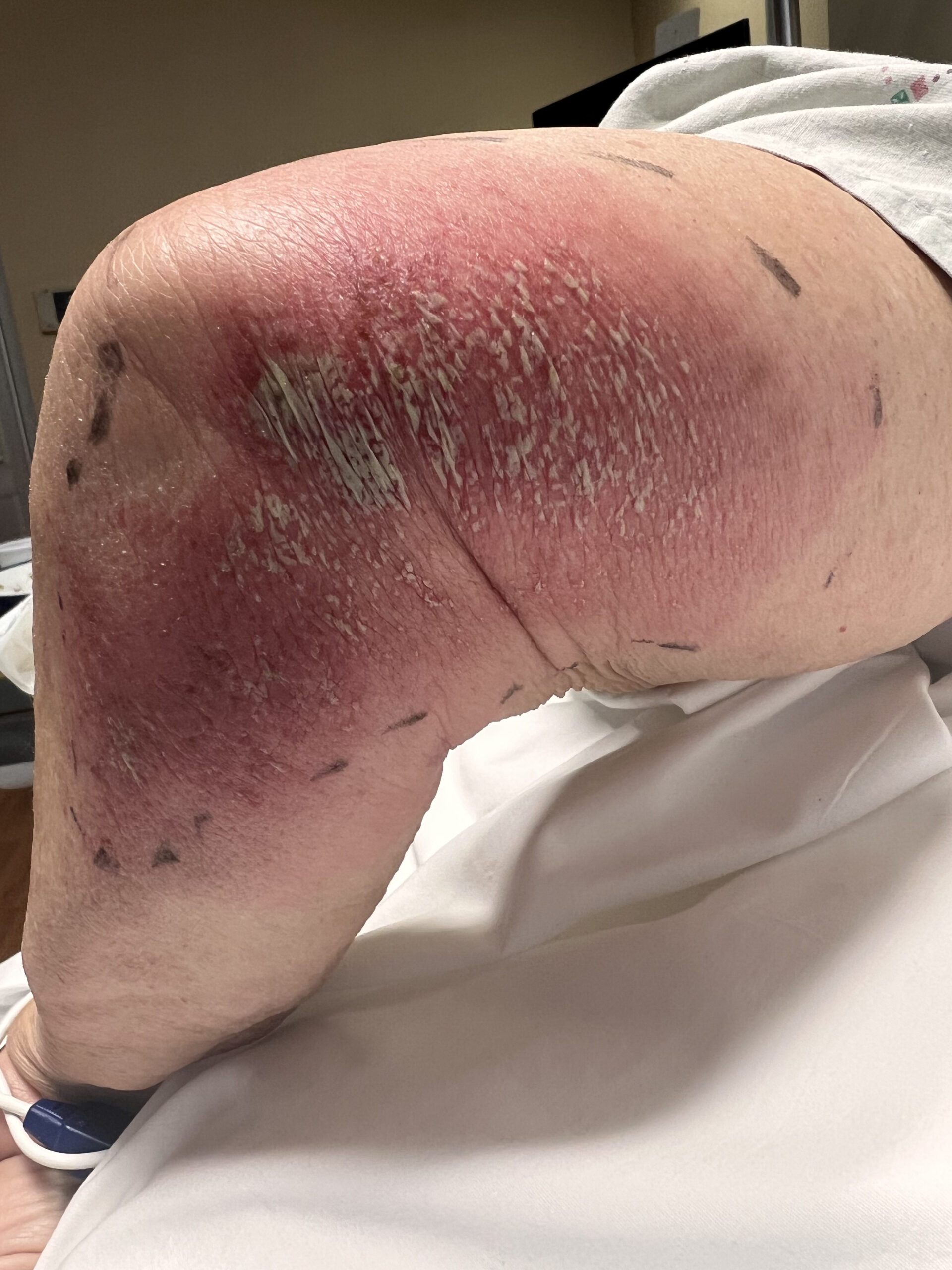 Acute Generalized Exanthematous Pustulosis - MD Searchlight