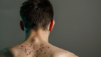 Acne Conglobata_4