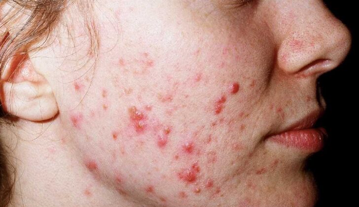 Acne Vulgaris