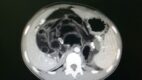 A large adrenal myelolipoma with predominantly fatty and intermixed intermediately attenuating components seen on CT