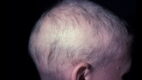 Alopecia Totalis With Regrowth.