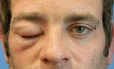Angioedema
